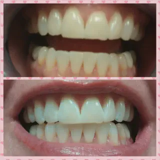 /img/25789-teeth-whitening-near-me-image7.webp