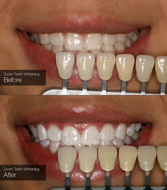 25790 zoom whitening aftercare