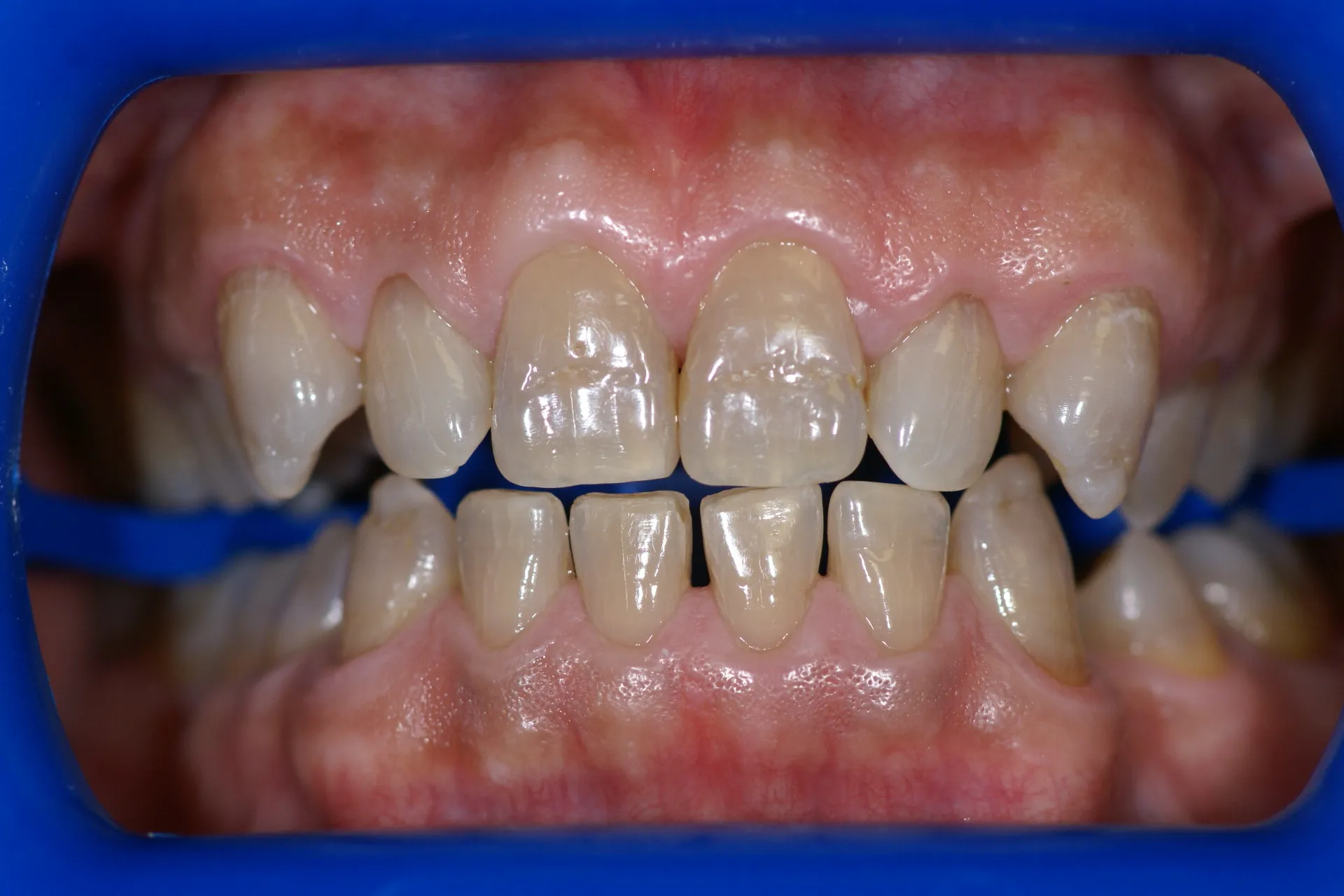25790 zoom whitening results