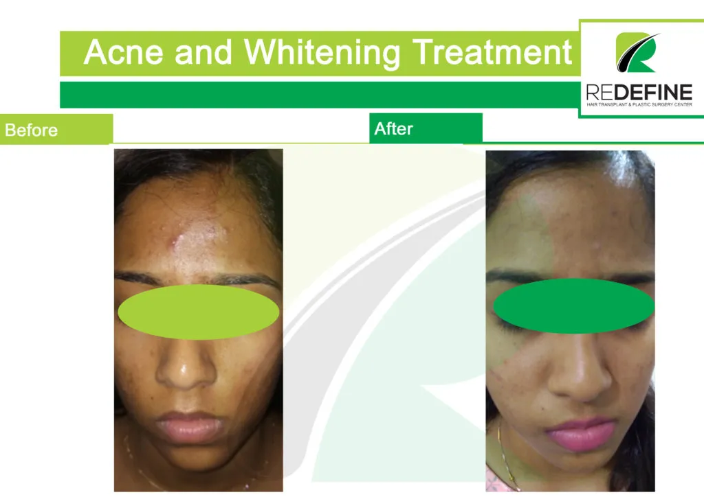 /img/25794-skin-whitening-post-treatment.webp