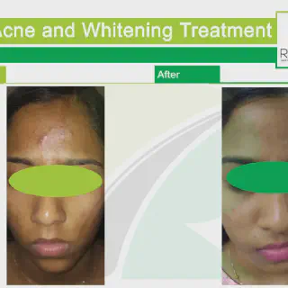 /img/25794-skin-whitening-post-treatment.webp