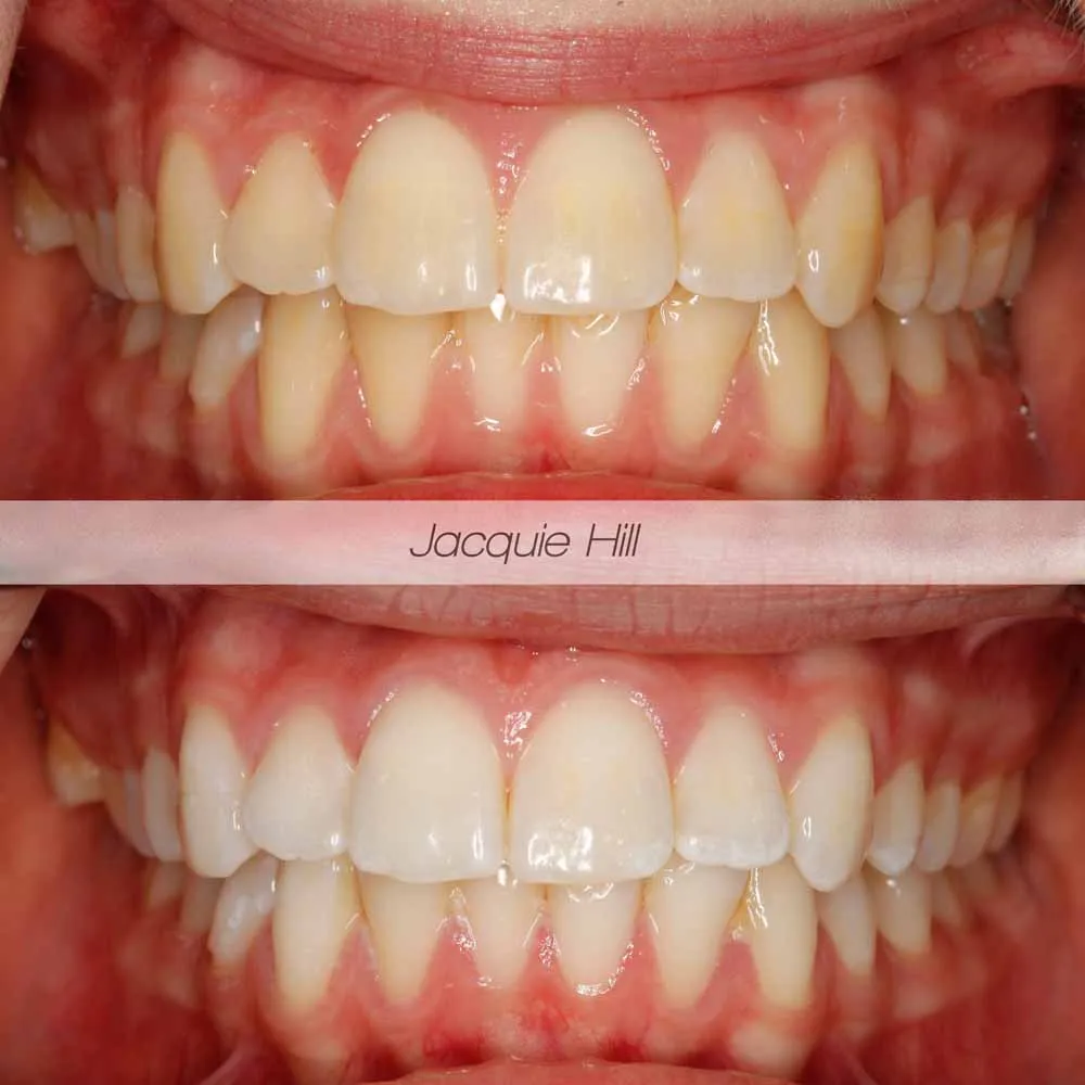 /img/25796-teeth-whitening-uk-smile.webp