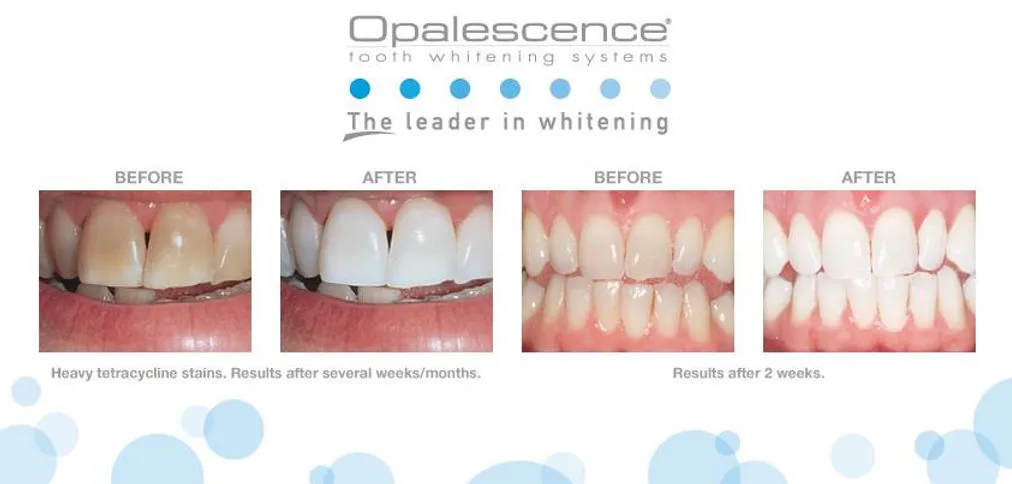 25812 opulence teeth whitening gel