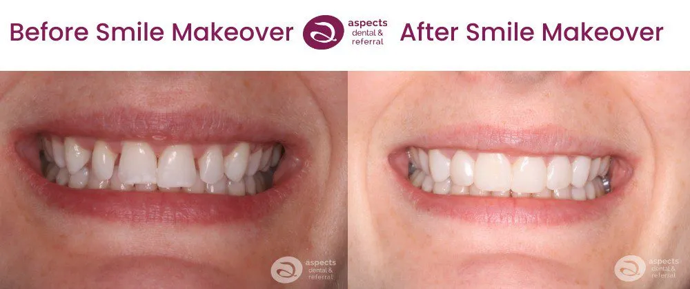 25818 at home teeth whitening kits