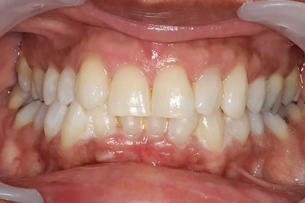 /img/25818-maintaining-white-smile.webp