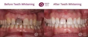 25818 professional teeth whitening