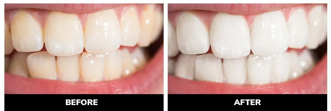 25820 teeth whitening colorado image4