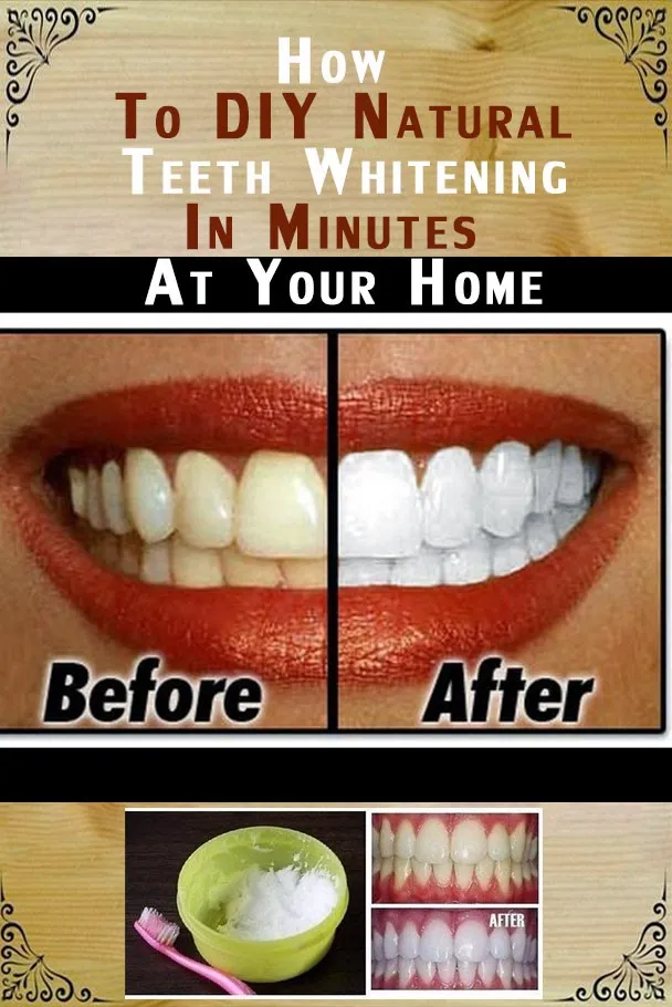 25822 teeth whitening results