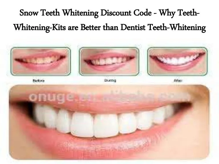 25830 spotlight teeth whitening strips