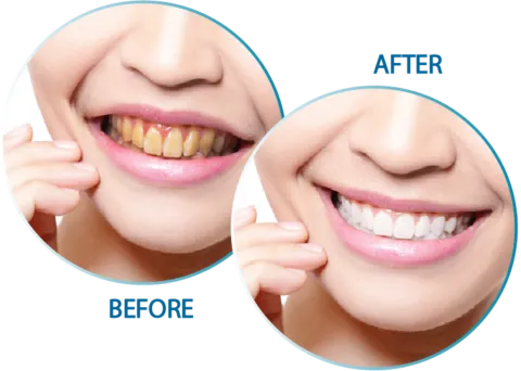 25831 seminyak teeth whitening at home