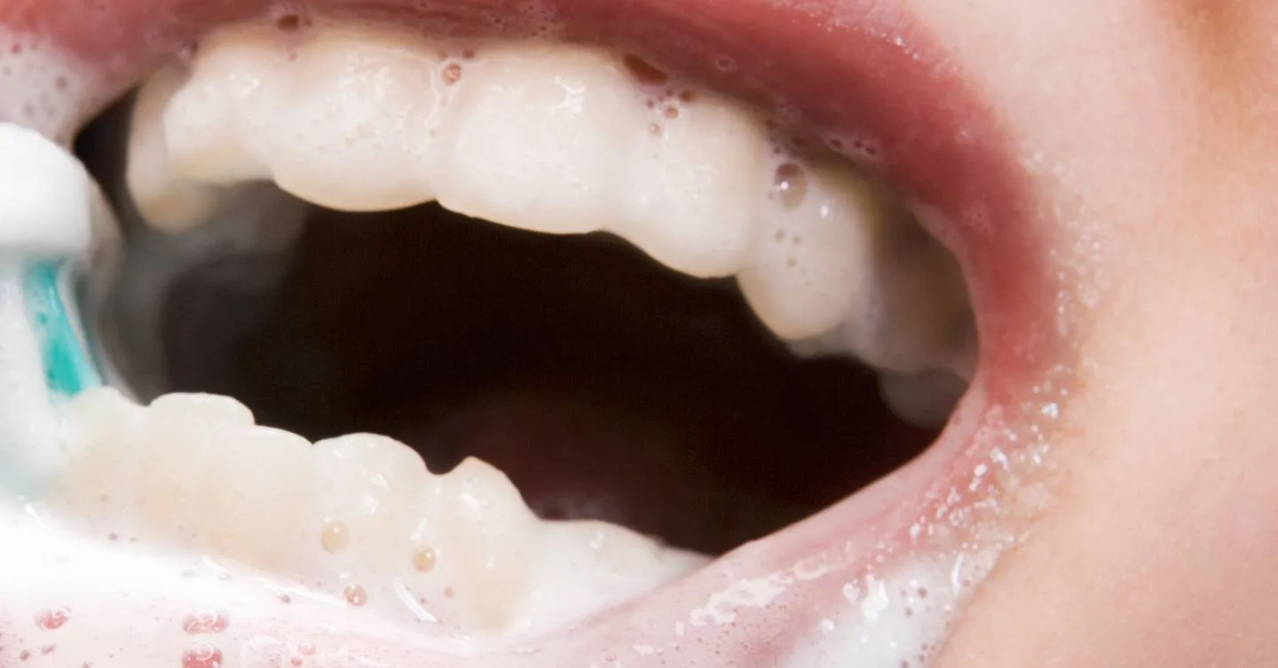25832 teeth whitening before after