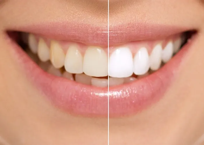 25833 sensitive teeth whitening overview