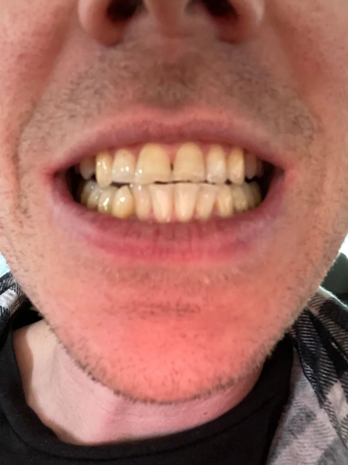 25835 icing teeth whitening 2