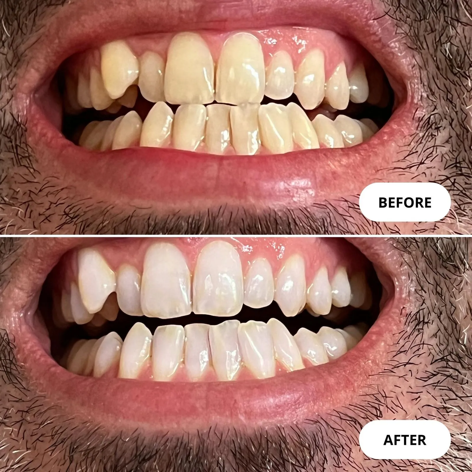 25835 icing teeth whitening 4