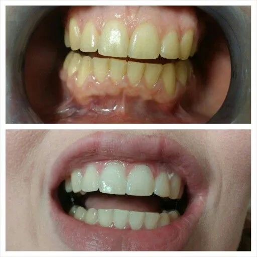 25835 icing teeth whitening 5