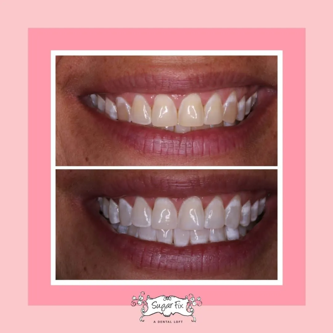 25835 icing teeth whitening 6