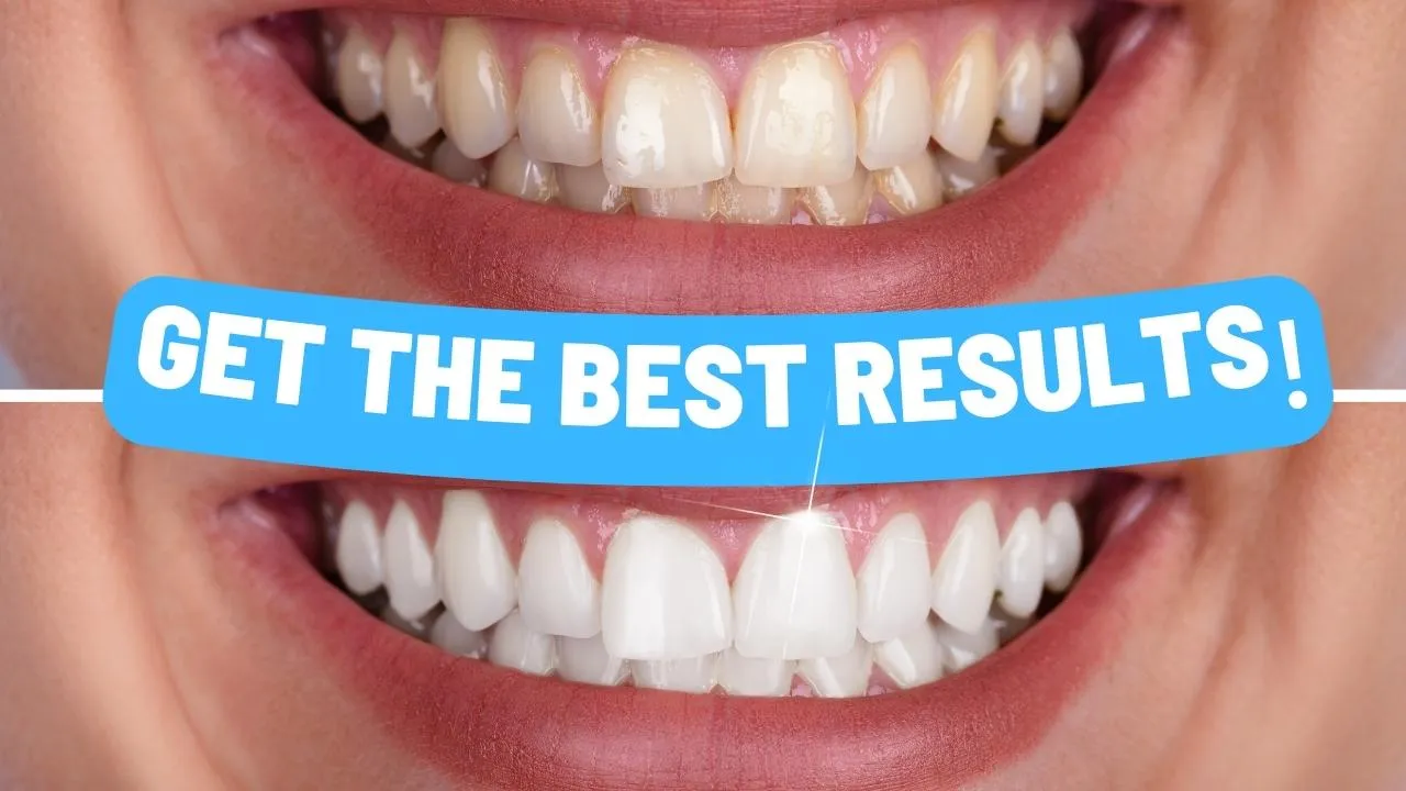 25839 teeth whitening maintenance