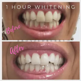 /img/25839-teeth-whitening-results.webp