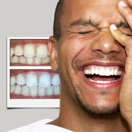 /img/25840-smiledirectclub-teeth-whitening-alternatives.webp