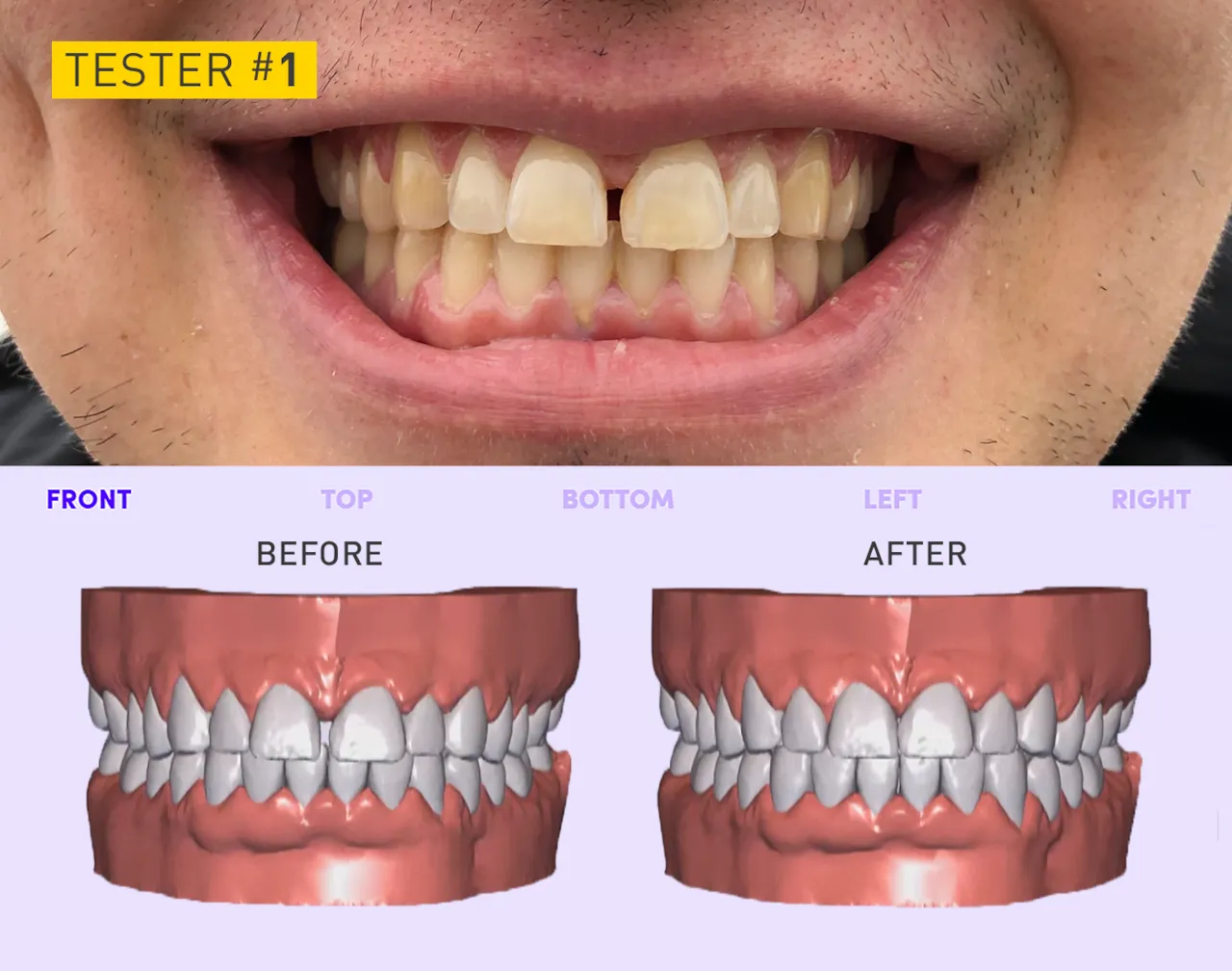 25840 smiledirectclub teeth whitening cost