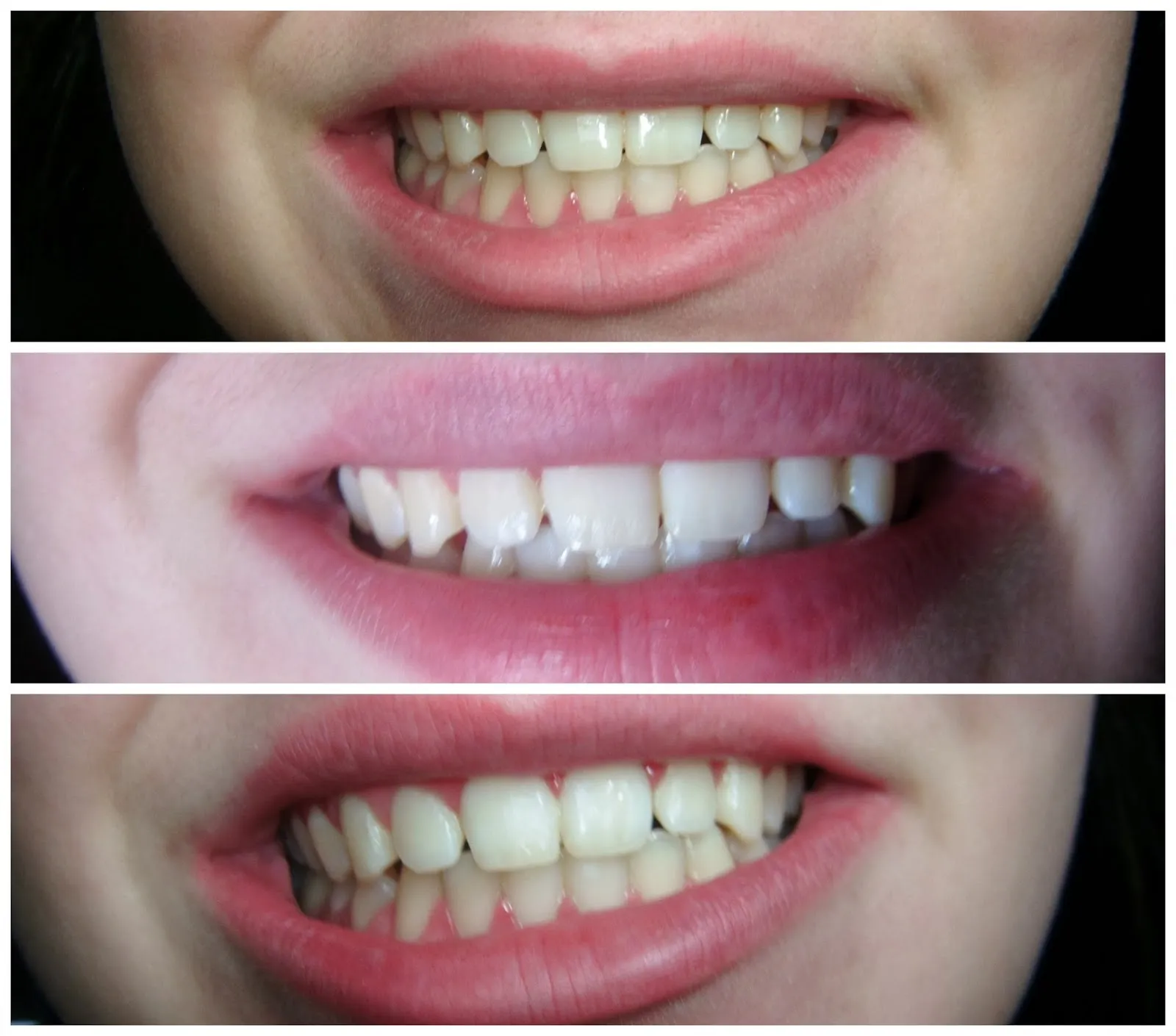 25842 teeth whitening foods drinks