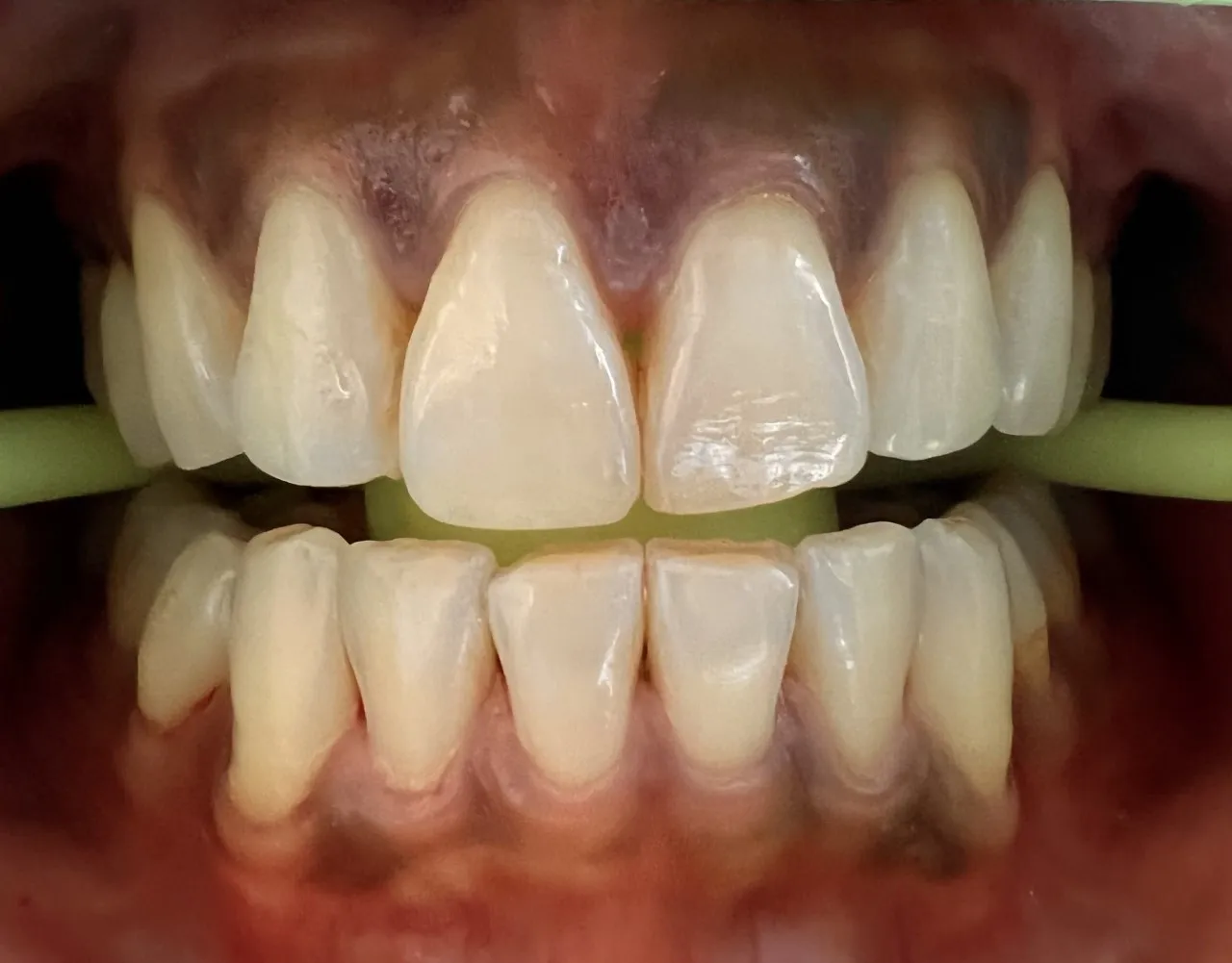 25843 bentonite clay teeth whitening