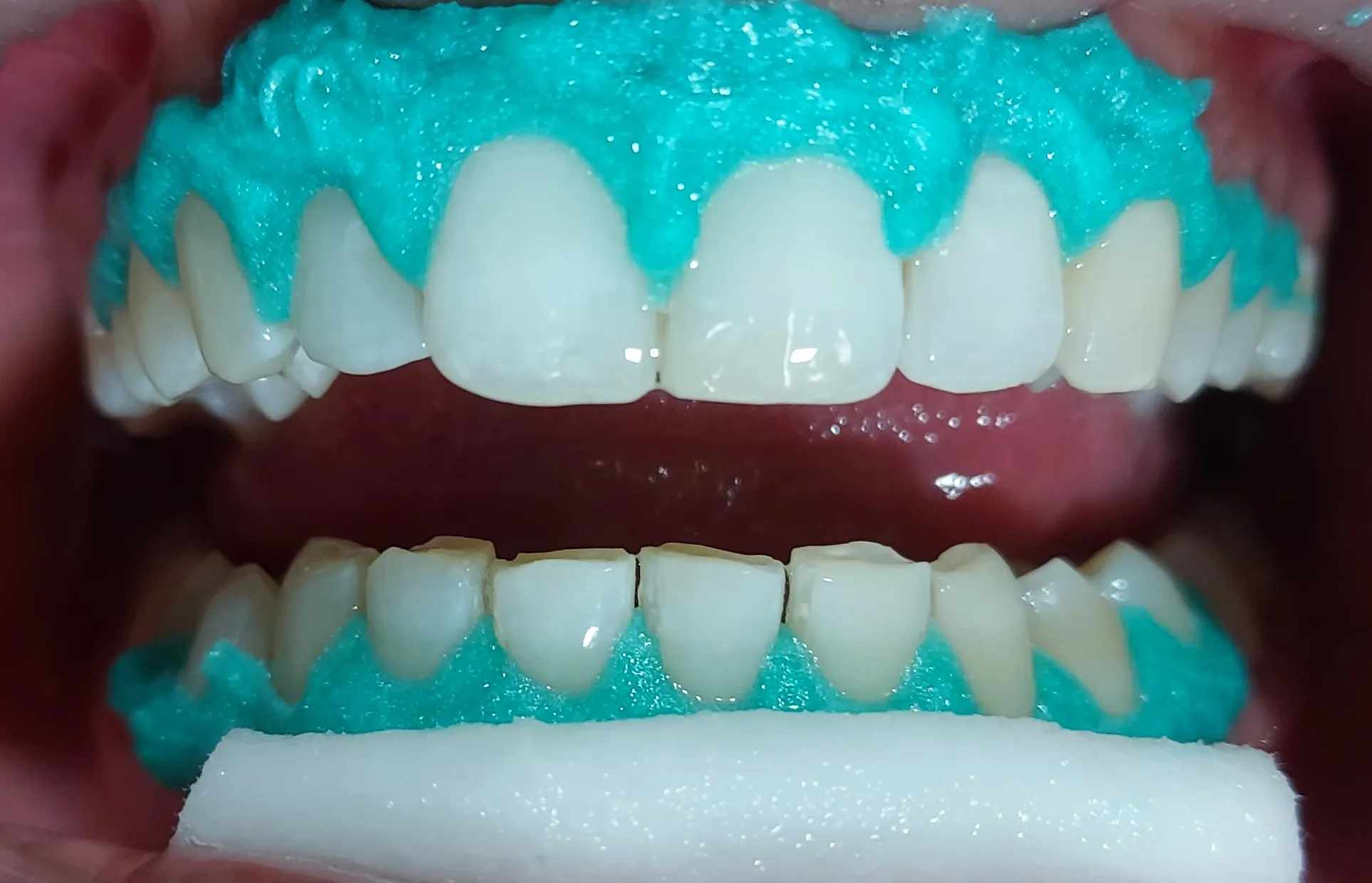 25843 brushing technique teeth whitening