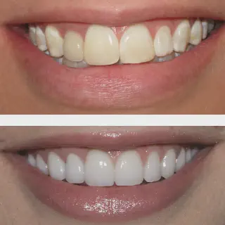 /img/25843-clay-teeth-whitening-results.webp