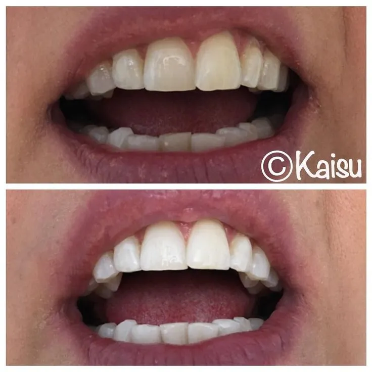 25843 healthy diet teeth whitening