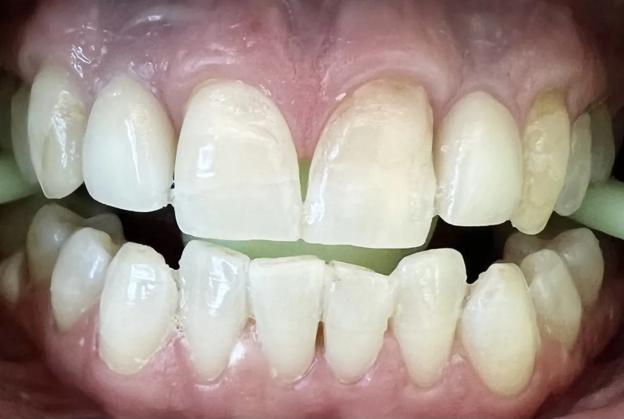 25843 kaolin clay teeth whitening