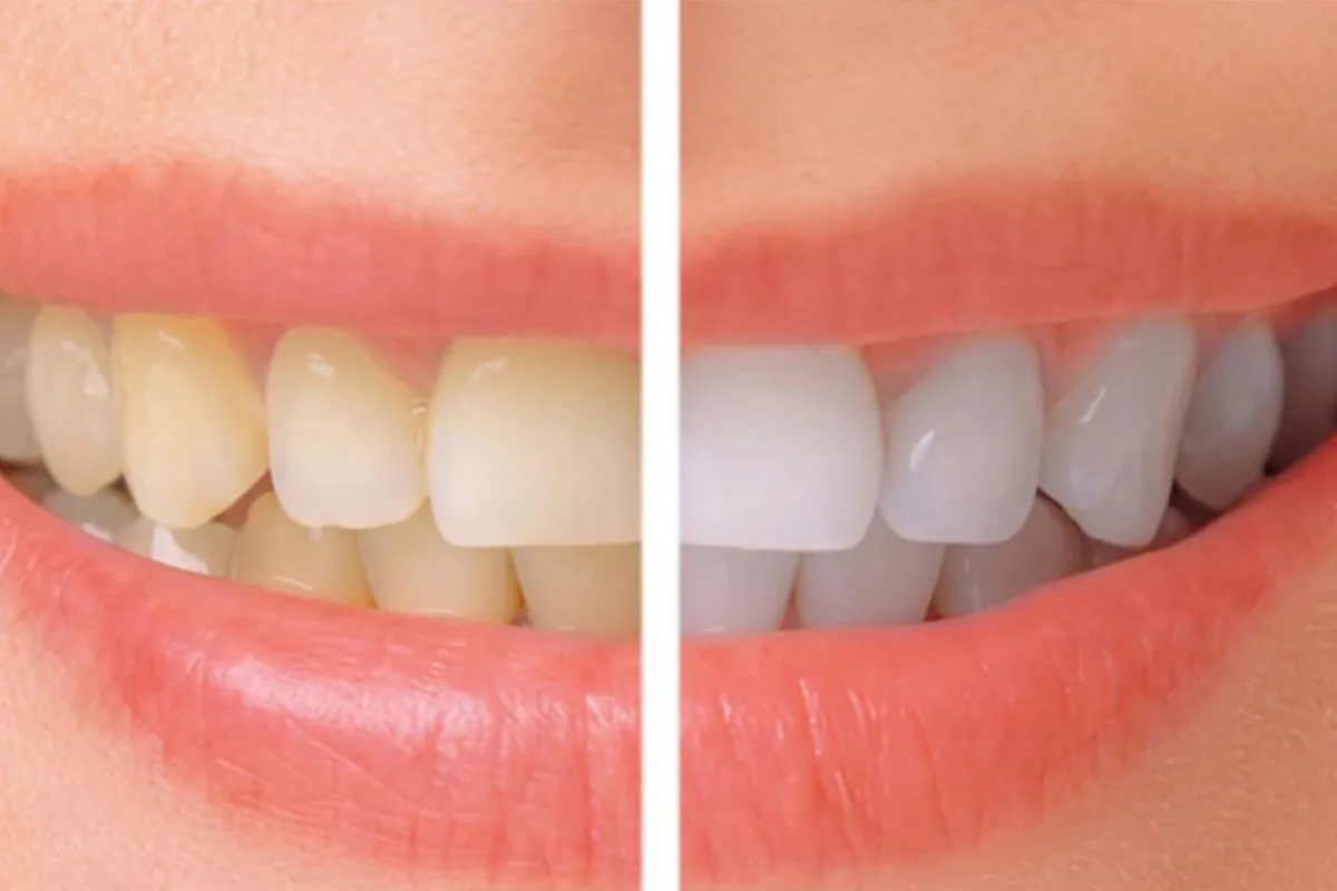 25843 types of clay teeth whitening