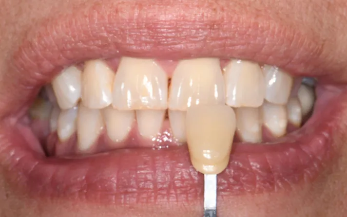 25846 professional teeth whitening scottsdale