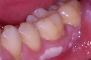 /img/25849-fluoride-treatment.webp
