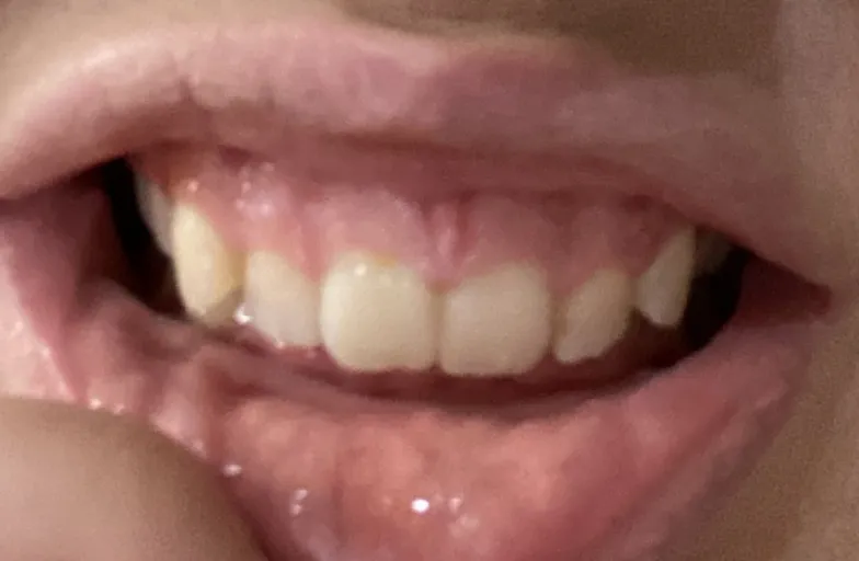 25849 uneven whitening
