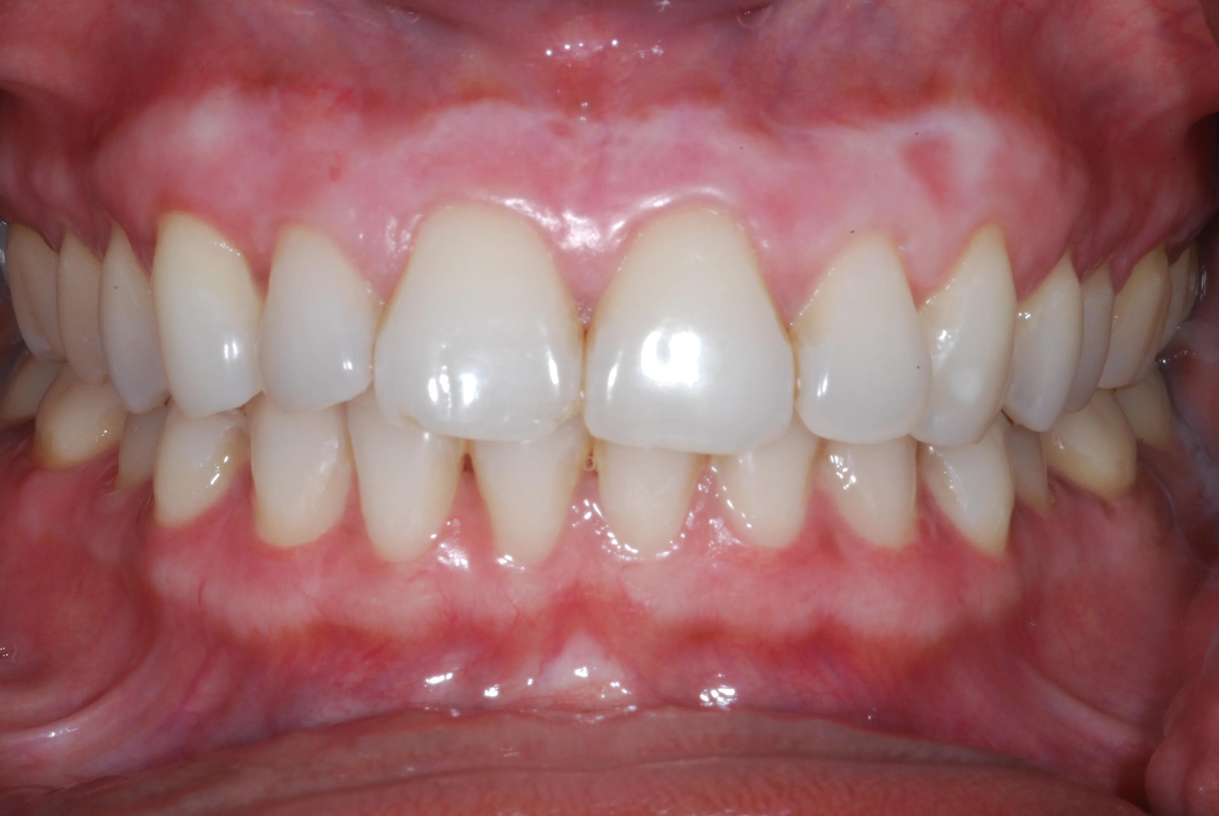 25849 white spots after whitening main