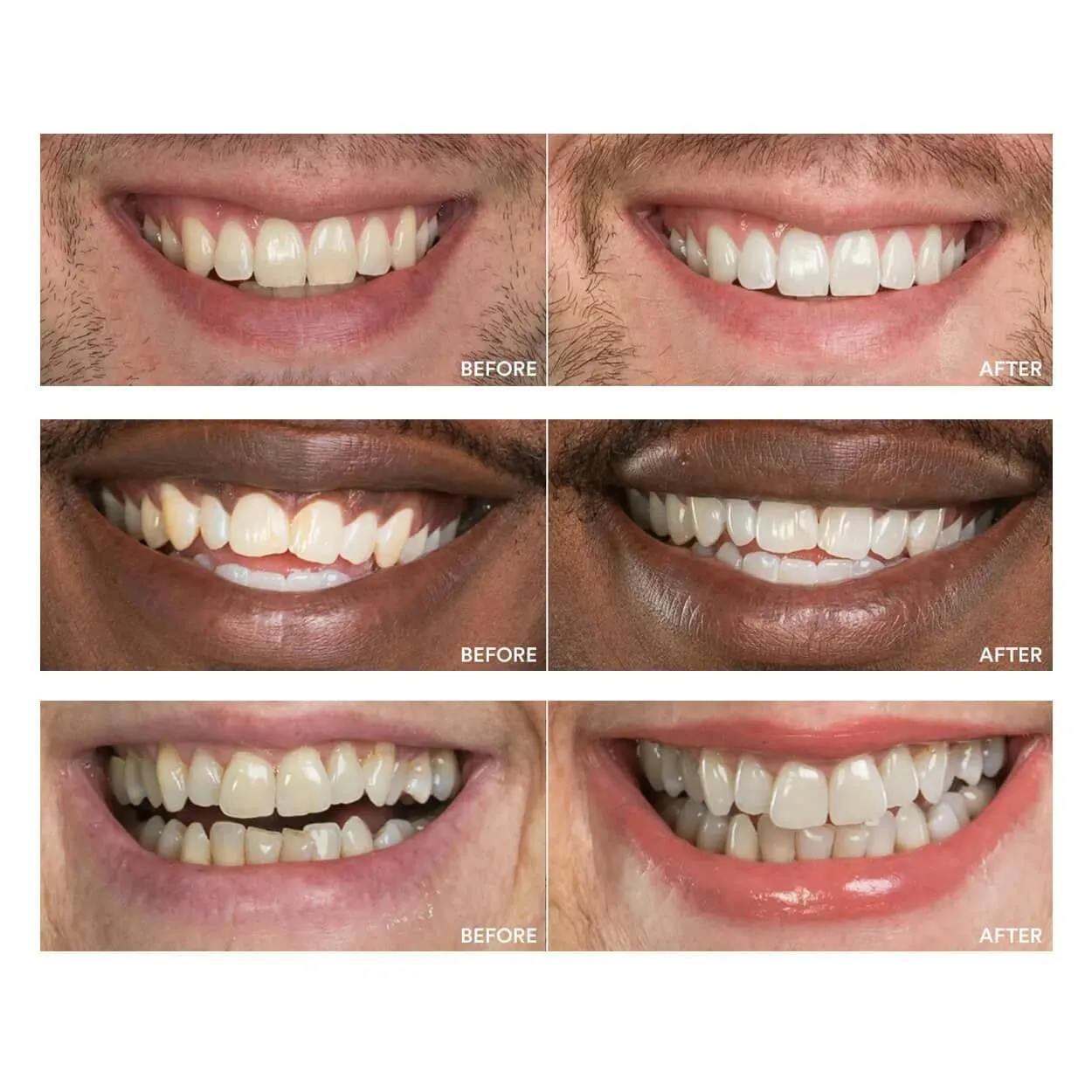 25850 teeth whitening sensitivity
