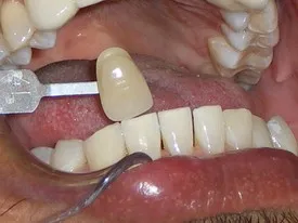 /img/25853-tooth-whitening-results.webp