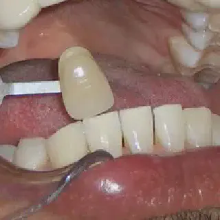 /img/25853-tooth-whitening-results.webp