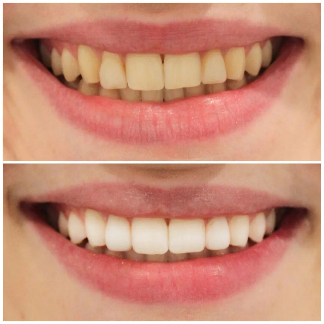 25854 white diet teeth whitening image5