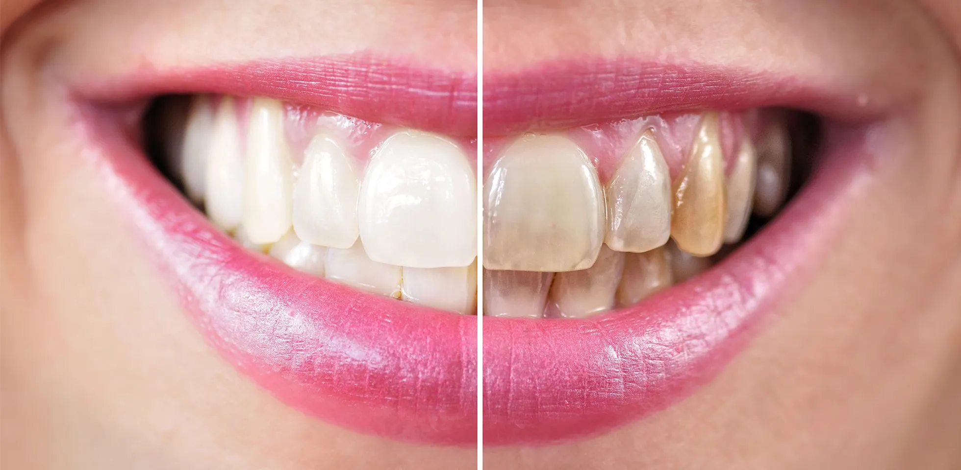 25854 white diet teeth whitening image6