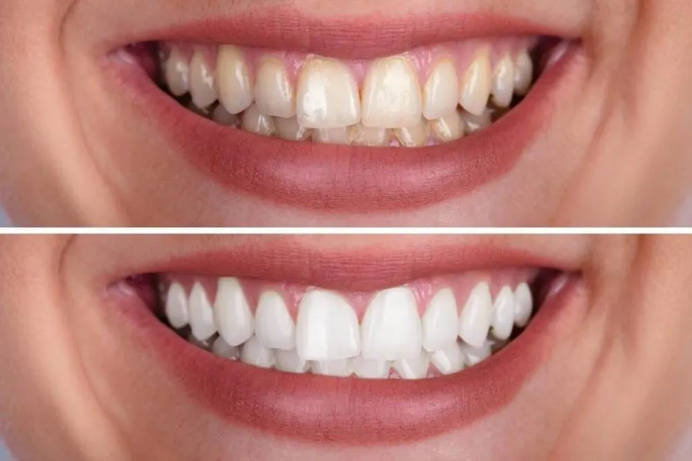 /img/25854-white-diet-teeth-whitening-image7.webp