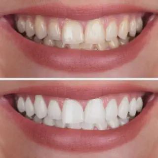 /img/25854-white-diet-teeth-whitening-image7.webp