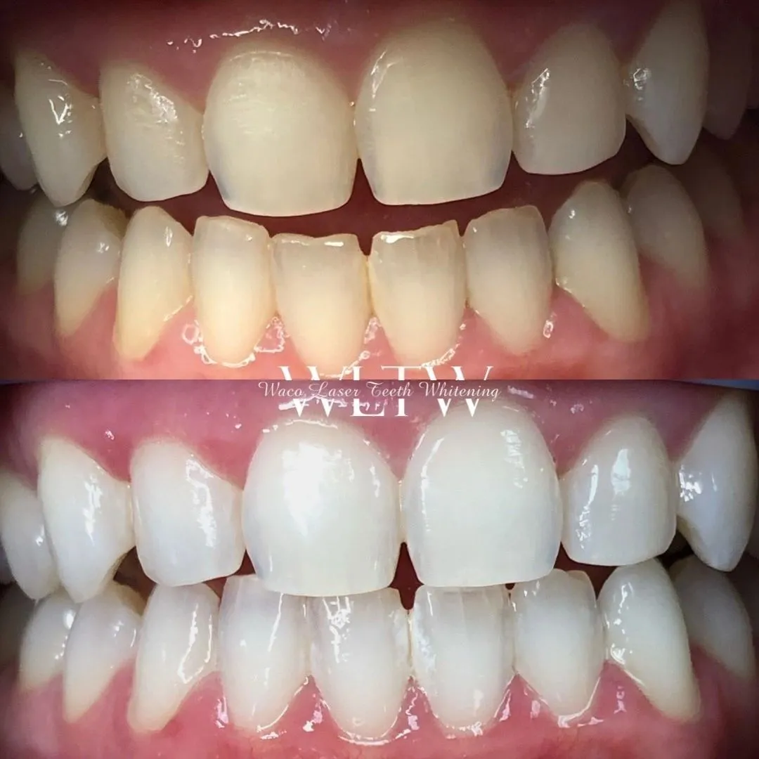 25856 teeth whitening waco tx before after