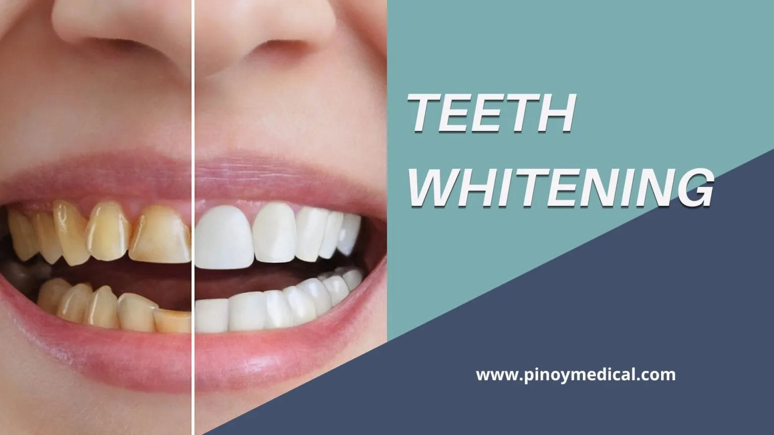 25867 in office teeth whitening