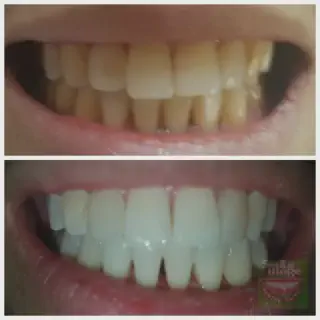 /img/25867-maintaining-white-smile.webp