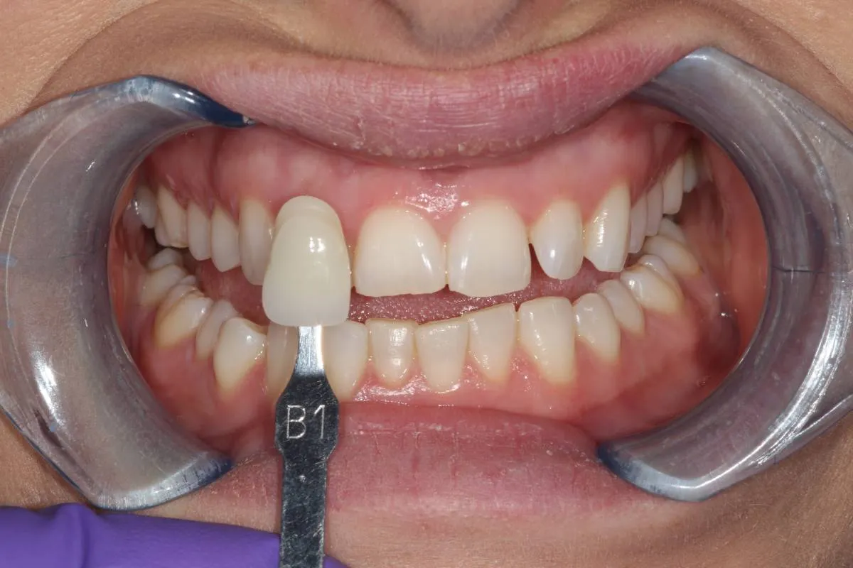 25868 chicken breast teeth whitening
