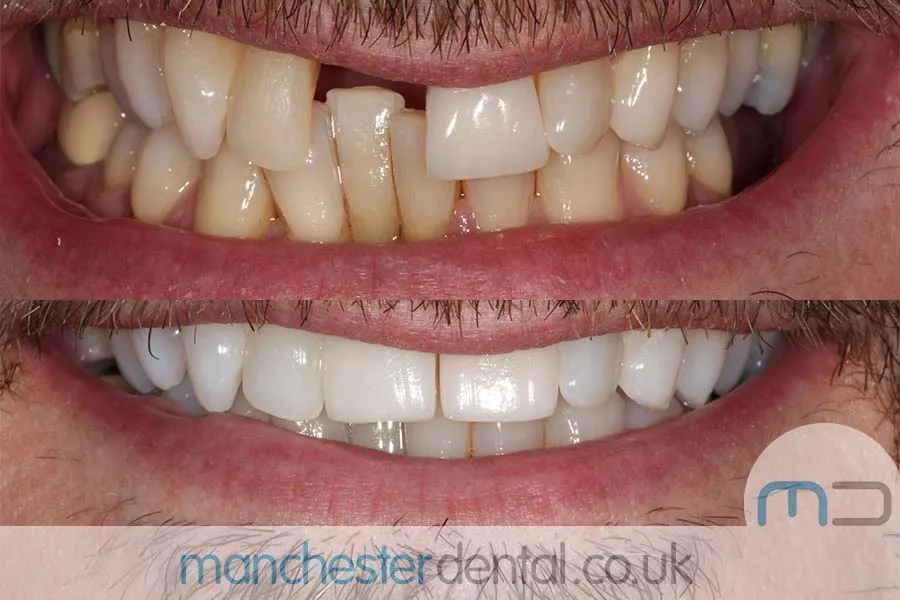 25869 teeth whitening manchester aftercare