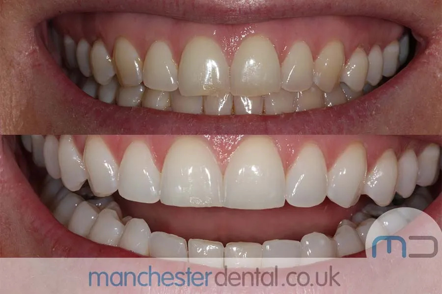25869 teeth whitening manchester before after