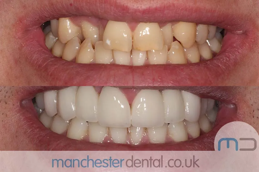 25869 teeth whitening options manchester