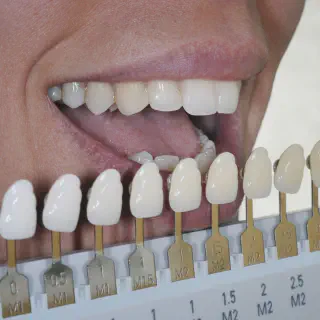 /img/25871-teeth-whitening-alternatives.webp